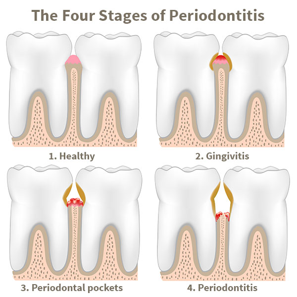 The Four Stages of Periodontitis - Clinton Family Dental IA