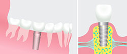 Dental Implant Restorations - Clinton Family Dental IA