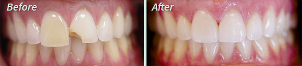 Porcelain Veneers at Clinton IA Dentist Clinton Family Dental