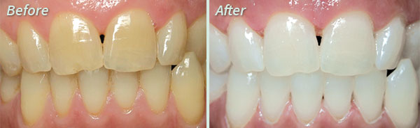 Professional Teeth Whitening at Clinton IA Dentist Clinton Family Dental